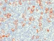 IHC testing of FFPE Hodgkin's Lymphoma with recombinant CD30 antibody (clone rCD30/412). Required HIER: boil tissue sections in 1mM EDTA, pH 7.5-8.5, for 10-20 min followed by cooling at RT for 20 min.