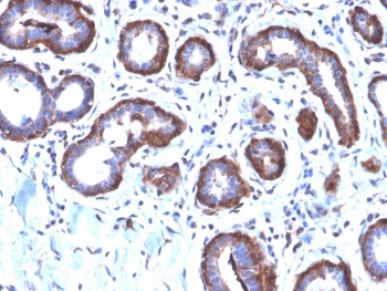 IHC testing of FFPE human breast carcinoma with recombinant Ferritin Light Chain antibody (clone FTL/2338R). Required HIER: boil tissue sections in pH6, 10mM citrate buffer, for 10-20 min followed by cooling at RT for 20 min.~