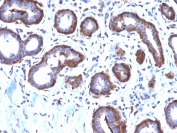 IHC testing of FFPE human breast carcinoma with recombinant Ferritin Light Chain antibody (clone FTL/2338R). Required HIER: boil tissue sections in pH6, 10mM citrate buffer, for 10-20 min followed by cooling at RT for 20 min.