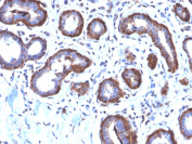Ferritin Light Chain Antibody Breast Cancer IHC. Immunohistochemistry testing of FFPE human breast carcinoma with recombinant Ferritin Light Chain antibody (clone FTL/2338R). Required HIER: boil tissue sections in pH6, 10mM citrate buffer, for 10-20 min followed by cooling at RT for 20 min.