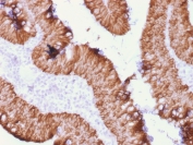 IHC testing of FFPE human rectal mass tissue with recombinant EpCAM antibody (clone rEGP40/1372). Required HIER: boil tissue sections in 10mM citrate buffer, pH 6, for 10-20 min followed by cooling at RT for 20 min. 