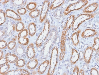 IHC testing of FFPE human renal cell carcinoma with Integrin beta 3 antibody (clone ITGB3/2166R). Required HIER: boil tissue sections in 10mM Tris with 1mM EDTA, pH9, for 10-20 min followed by cooling at RT for 20 min.~