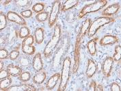 IHC testing of FFPE human renal cell carcinoma with Integrin beta 3 antibody (clone ITGB3/2166R). Required HIER: boil tissue sections in 10mM Tris with 1mM EDTA, pH9, for 10-20 min followed by cooling at RT for 20 min.