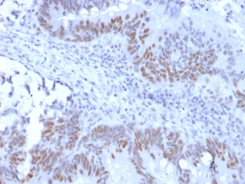 IHC testing of recombinant RB1 antibody and FFPE human colon carcinoma (clone RB1/2313R). Required HIER: boil tissue sections in 10mM citrate buffer, pH 6, for 10-20 min followed by cooling at RT for 20 min.~