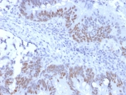 IHC testing of recombinant RB1 antibody and FFPE human colon carcinoma (clone RB1/2313R). Required HIER: boil tissue sections in 10mM citrate buffer, pH 6, for 10-20 min followed by cooling at RT for 20 min.