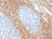 CD52 Antibody Tonsil IHC. Immunohistochemistry analysis of CD52 / Campath-1 antigen expression in FFPE human tonsil tissue using a recombinant rabbit monoclonal antibody, clone CD52/2276R. Strong membranous and cytoplasmic HRP-DAB brown staining is observed in lymphocytes within interfollicular regions and surrounding germinal centers, while germinal center cells show comparatively reduced signal; nuclei are counterstained blue. This staining pattern is consistent with the known distribution of CD52 on mature lymphoid cells. Antigen retrieval was performed by boiling sections in 10 mM citrate buffer, pH 6, for 10-20 min followed by cooling at room temperature before immunohistochemistry processing.
