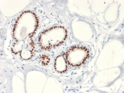 IHC testing of FFPE human breast cancer with Estrogen Receptor antibody (clone ESR1/2299R). Required HIER: boil tissue sections in 10mM citrate buffer, pH 6, for 10-20 min followed by cooling at RT for 20 min. 