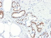 IHC testing of FFPE human breast cancer with Estrogen Receptor alpha antibody (clone rESR1/1935). Required HIER: boil tissue sections in 10mM citrate buffer, pH 6, for 10-20 min followed by cooling at RT for 20 min. 