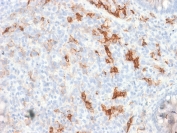 IHC testing of FFPE human melanoma tissue with recombinant p75NTR antibody. Required HIER: boil tissue sections in pH6, 10mM citrate buffer, for 10-20 min followed by cooling at RT for 20 min.