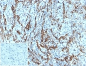 IHC testing of FFPE human melanoma tissue with recombinant p75NTR antibody. Required HIER: boil tissue sections in pH9 EDTA buffer, for 10-20 min followed by cooling at RT for 20 min. Negative control inset: PBS used instead of primary antibody to control for secondary Ab binding.