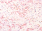 IHC testing of FFPE human melanoma with recombinant TRP1 antibody (clone TYPR1/2340R). Required HIER: boil tissue sections in pH 9 10mM Tris with 1mM EDTA for 10-20 min followed by cooling at RT for 20 min.