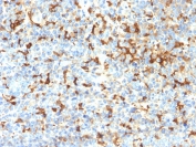 IHC testing of FFPE human melanoma with recombinant TRP1 antibody (clone TYPR1/2340R). Required HIER: boil tissue sections in pH 9 10mM Tris with 1mM EDTA for 10-20 min followed by cooling at RT for 20 min.