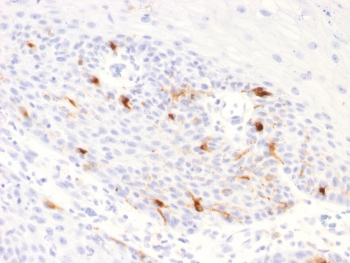IHC testing of FFPE human basal cell carcinoma with recombinant TRP1 antibody (clone TYPR1/2340R). Required HIER: boil tissue sections in pH 9 10mM Tris with 1mM EDTA for 10-20 min followed by cooling at RT for 20 min.~