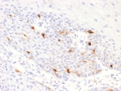 IHC testing of FFPE human basal cell carcinoma with recombinant TRP1 antibody (clone TYPR1/2340R). Required HIER: boil tissue sections in pH 9 10mM Tris with 1mM EDTA for 10-20 min followed by cooling at RT for 20 min.