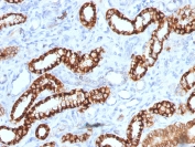 IHC testing of FFPE human renal cell carcinoma with recombinant Cadherin 16 antibody (clone rCDH16/1071). Required HIER: boil tissue sections in 10mM Tris with 1mM EDTA, pH 9, for 10-20 min followed by cooling at RT for 20 min.