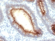 IHC testing of FFPE human colon carcinoma with CEA antibody (clone rC66/1009). Required HIER: boil tissue sections in pH 9 10mM Tris with 1mM EDTA for 10-20 min followed by cooling at RT for 20 min.