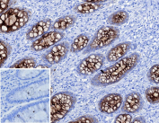 CEA Antibody Colon Carcinoma IHC. Immunohistochemistry analysis of CEA / CEACAM5 expression in FFPE human colon carcinoma using CEA antibody clone C66/1983R. Tumor epithelial cells show strong membranous and cytoplasmic HRP-DAB brown staining with glandular distribution, while surrounding stromal cells remain largely negative; nuclei are counterstained blue. Inset shows a PBS-only negative control processed without primary antibody, confirming minimal non-specific background staining.