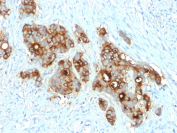 CD66 Antibody Colon Carcinoma IHC. Immunohistochemistry analysis of CD66 / CEA (CEACAM5) expression in FFPE human colon carcinoma using recombinant rabbit monoclonal antibody clone C66/2055R. Tumor epithelial cells show strong membranous and cytoplasmic HRP-DAB brown staining within gland-forming regions, while surrounding stromal cells remain largely negative; nuclei are counterstained blue. This CD66 antibody highlights carcinoembryonic antigen expression consistent with epithelial tumor origin. Antigen retrieval was performed by boiling sections in 10 mM Tris buffer with 1 mM EDTA, pH 9, for 10-20 min followed by cooling at room temperature.