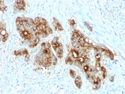 IHC testing of FFPE human colon carcinoma with CD66 antibody (clone C66/2055R). Required HIER: boil tissue sections in pH 9 10mM Tris with 1mM EDTA for 10-20 min followed by cooling at RT for 20 min.
