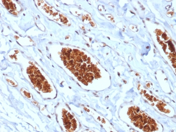 IHC testing of FFPE human angiosarcoma with recombinant GYPA antibody (clone rGYPA/280). Required HIER: boil tissue sections in 10mM citrate buffer, pH 6, for 10-20 min.~