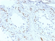 IHC testing of FFPE human testis with recombinant WT1 antibody (clone rWT1/857). Required HIER: boil tissue sections in pH 9 10mM Tris with 1mM EDTA for 10-20 min followed by cooling at RT for 20 min.