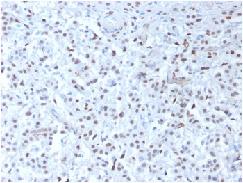 IHC testing of FFPE human mesothelioma with recombinant WT1 antibody (clone rWT1/857). Required HIER: boil tissue sections in pH 9 10mM Tris with 1mM EDTA for 10-20 min followed by cooling at RT for 20 min.~
