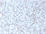 IHC testing of FFPE human mesothelioma with recombinant WT1 antibody (clone rWT1/857). Required HIER: boil tissue sections in pH 9 10mM Tris with 1mM EDTA for 10-20 min followed by cooling at RT for 20 min.