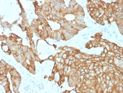 IHC testing of FFPE human colon carcinoma with recombinant CK19 antibody (clone rKRT19/800). Required HIER: boil tissue sections in pH 9 10mM Tris with 1mM EDTA for 10-20 min followed by cooling at RT for 20 min.