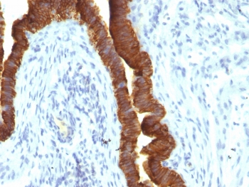 IHC testing of FFPE human ovarian carcinoma with recombinant EpCAM antibody (clone rEPG40/1110). Required HIER: boil tissue sections in 10mM citrate buffer, pH 6, for 10-20 min followed by cooling at RT for 20 min.~