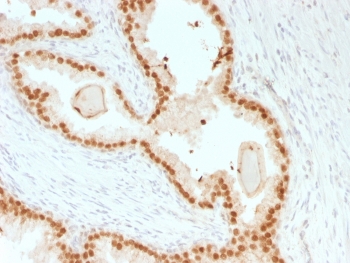 IHC testing of FFPE human prostate carcinoma with recombinant FOXA1 antibody (clone rFOXA1/1515). HIER: boil sections in 10mM Tris with 1mM EDTA, pH9 for 10-20 min followed by cooling at RT for 20 min.~