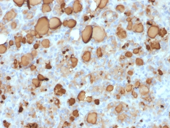 IHC: Formalin-fixed, paraffin-embedded human thyroid carcinoma stained with recombinant TG antibody (clone rTGB24). Required HIER: boil tissue sections in pH 9 10mM Tris with 1mM EDTA for 10-20 min followed by cooling at RT for 20 min.~