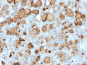 IHC: Formalin-fixed, paraffin-embedded human thyroid carcinoma stained with recombinant TG antibody (clone rTGB24). Required HIER: boil tissue sections in pH 9 10mM Tris with 1mM EDTA for 10-20 min followed by cooling at RT for 20 min.