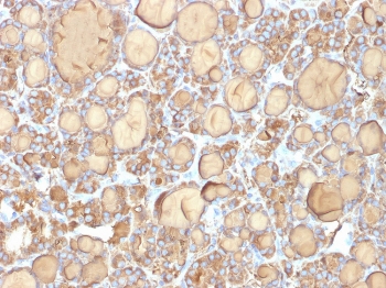 IHC: Formalin-fixed, paraffin-embedded human thyroid gland stained with recombinant TG antibody (clone r6E1). Required HIER: boil tissue sections in pH 9 10mM Tris with 1mM EDTA for 10-20 min followed by cooling at RT for 20 min.~