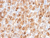 IHC: Formalin-fixed, paraffin-embedded human thyroid gland stained with recombinant Thyroglobulin antibody (clone r2H11). Required HIER: boil tissue sections in pH 9 10mM Tris with 1mM EDTA for 10-20 min followed by cooling at RT for 20 min.