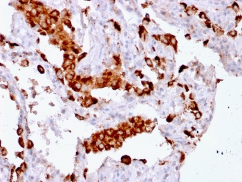 IHC testing of FFPE human lung adenocarcinoma with recombinant Napsin A antibody (clone rNAPSA/1239). Required HIER: boil tissue sections in pH6, 10mM citrate buffer, for 10-20 min followed by cooling at RT for 20 min.~