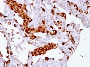 IHC testing of FFPE human lung adenocarcinoma with recombinant Napsin A antibody (clone rNAPSA/1239). Required HIER: boil tissue sections in pH6, 10mM citrate buffer, for 10-20 min followed by cooling at RT for 20 min.