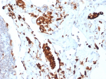 IHC testing of FFPE human lung adenocarcinoma with recombinant Napsin A antibody (clone NAPSA/1865R). Required HIER: boil tissue sections in pH 9 10mM Tris with 1mM EDTA for 10-20 min followed by cooling at RT for 20 min.~