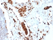 IHC testing of FFPE human lung adenocarcinoma with recombinant Napsin A antibody (clone NAPSA/1865R). Required HIER: boil tissue sections in pH 9 10mM Tris with 1mM EDTA for 10-20 min followed by cooling at RT for 20 min.