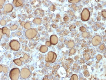 IHC testing of FFPE human thyroid gland with recombinant TG antibody (clone TGB/1970R). Required HIER: boil tissue sections in pH 9 10mM Tris with 1mM EDTA for 10-20 min followed by cooling at RT for 20 min.~