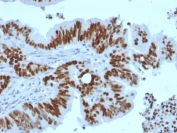 IHC testing of FFPE human colon carcinoma with recombinant p53 antibody (clone TP53/2092R). Required HIER: boil tissue sections in pH6, 10mM citrate buffer, for 10-20 min followed by cooling at RT for 20 min.
