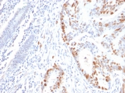 IHC testing of FFPE human colon carcinoma with recombinant TP53 antibody. Required HIER: boil tissue sections in pH6, 10mM citrate buffer, for 10-20 min followed by cooling at RT for 20 min.
