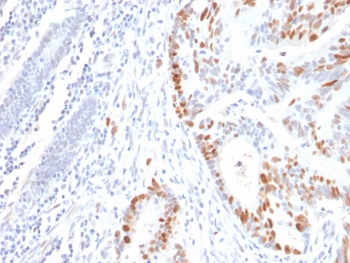 IHC testing of FFPE human colon carcinoma with recombinant TP53 antibody. Required HIER: boil tissue sections in pH6, 10mM citrate buffer, for 10-20 min followed by cooling at RT for 20 min.~