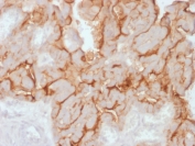 IHC testing of FFPE human ovarian carcinoma with recombinant MUC16 antibody (clone OCA125/2349R). Required HIER: steam section in pH6 citrate buffer for 20 min and allow to cool prior to testing.