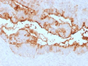 IHC testing of FFPE human endometrial carcinoma with recombinant MUC16 antibody (clone OCA125/2349R). Required HIER: steam section in pH6 citrate buffer for 20 min and allow to cool prior to testing.~