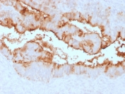 IHC testing of FFPE human endometrial carcinoma with recombinant MUC16 antibody (clone OCA125/2349R). Required HIER: steam section in pH6 citrate buffer for 20 min and allow to cool prior to testing.