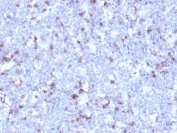 IHC testing of FFPE human lymphoma with recombinant CD43 antibody (clone rSPN/1094). Required HIER: boil tissue sections in 10mM citrate buffer, pH 6, for 10-20 min followed by cooling at RT for 20 min.