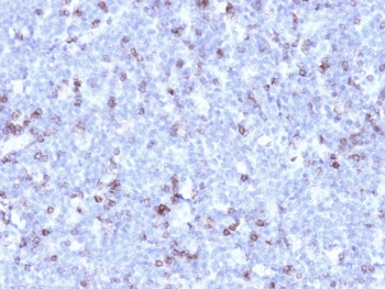 IHC testing of FFPE human lymphoma with recombinant CD43 antibody (clone rSPN/1094). Required HIER: boil tissue sections in 10mM citrate buffer, pH 6, for 10-20 min followed by cooling at RT for 20 min.
