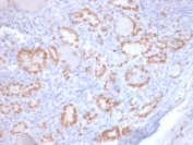IHC: Formalin-fixed, paraffin-embedded human lung adenocarcinoma stained with recombinant TTF-1 antibody (clone rNX2.1/690). Required HIER: boil tissue sections in pH6, 10mM citrate buffer, for 10-20 min followed by cooling at RT for 20 min.