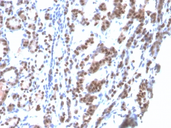 IHC: Formalin-fixed, paraffin-embedded human thyroid stained with recombinant TTF-1 antibody (clone rNX2.1/690). Required HIER: boil tissue sections in pH6, 10mM citrate buffer, for 10-20 min followed by cooling at RT for 20 min.~