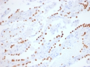 IHC: Formalin-fixed, paraffin-embedded human lung adenocarcinoma stained with recombinant NKX2.1 antibody (clone NX2.1/1855R). Required HIER: boil tissue sections in pH6, 10mM citrate buffer, for 10-20 min followed by cooling at RT for 20 min.